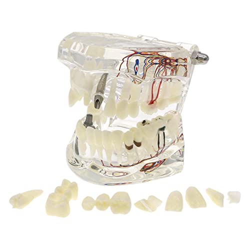 Reparo neural do implante dentário do doença de implante patológico dentes removíveis de doenças transparentes dentes de dentes com ponte de implante dental, modelo odontológico para educação do paciente e do aluno odontológico