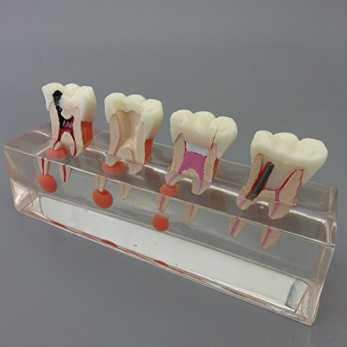 Modelo de dentes dentários modelo de tratamento endodôntico de 4 estágios para estudar e ensinar…